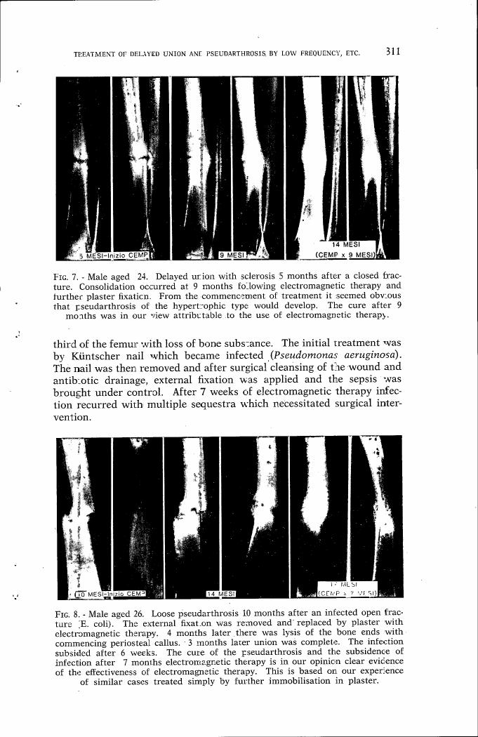 AI-described figure: X-ray images showing progression of bone healing over time in two patients with delayed union and pseudarthrosis.