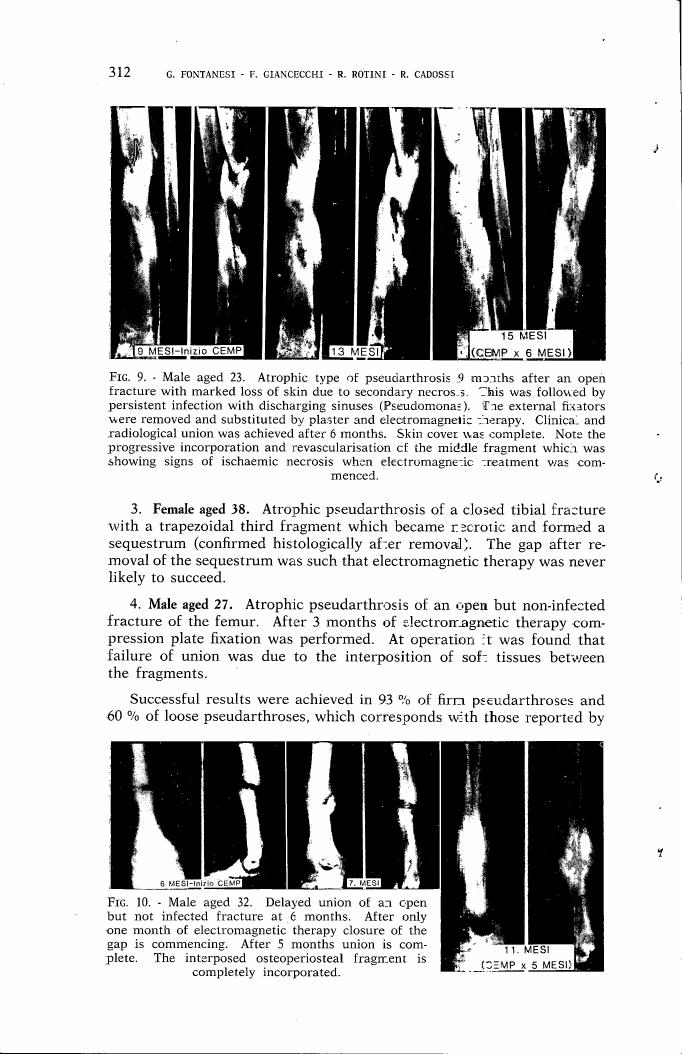 AI-described figure: Figure 9 illustrates a case study of an atrophic type of pseudarthrosis in a male aged 23 following an open fracture, showing the progression over time with electromagnetic therapy.