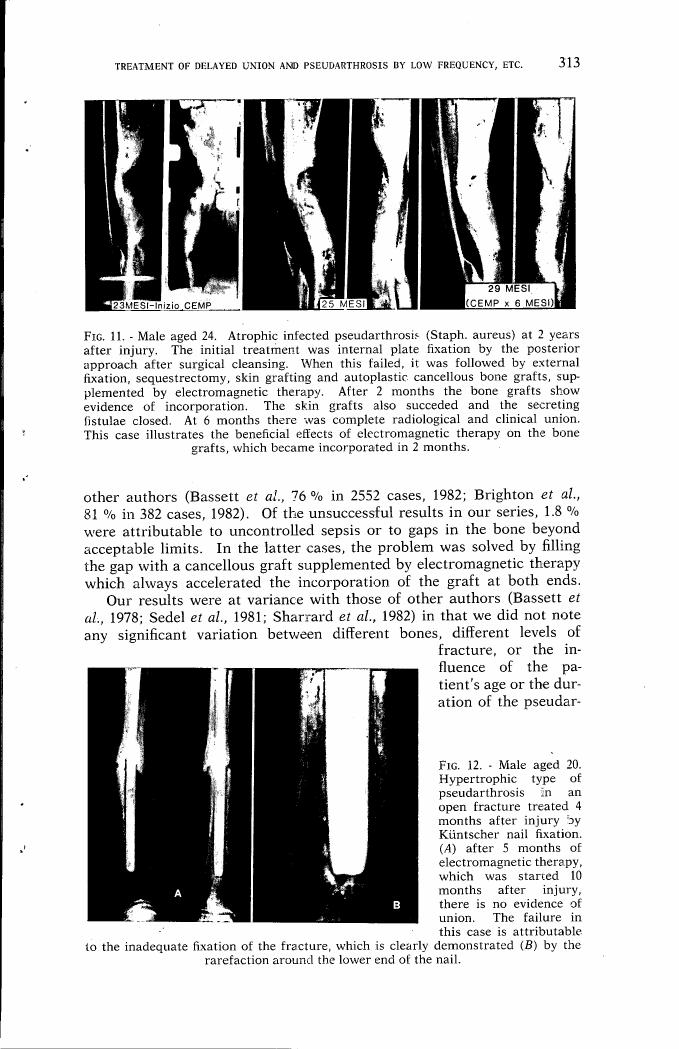 AI-described figure: Fig. 12: Male aged 20 with hypertrophic type of pseudarthrosis in an open fracture treated 4 months after injury by Kuntscher nail fixation, showing the progression over time.